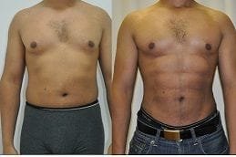 Six Pack Abs Surgery 5 Best six-pack-abs-surgery in dubai