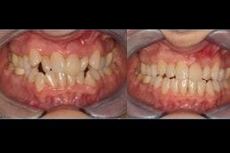 Soft Tissue Dental Laser 4 Best soft-tissue-dental-laser Clinic in Dubai