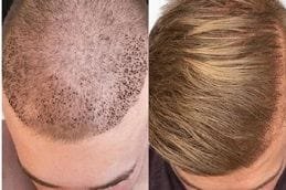Best turkish-hair-transplant Clinic in Dubai