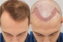 Turkish Hair Transplant 7 Best turkish-hair-transplant in Abu Dhabi