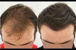 Turkish Hair Transplant 12 Best turkish-hair-transplant in dubai