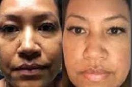 Best vampire-facelift Clinic in Dubai