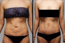 Body Contouring Dubai Silicon Oasis Before & After