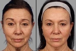 Botox Injection Dubai 5 Botox Before & After