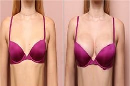 Breast Augmentation 5 Breast Augmentation Clinic Dubai