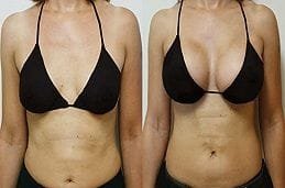 Breast Augmentation 4 Breast Augmentation Clinic in Dubai