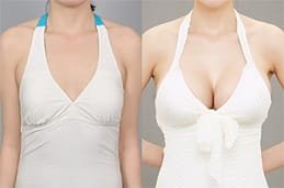 Breast Augmentation 6 Breast Augmentation Dubai,UAE