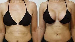 Breast Surgery Dubai