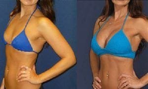 Breast Surgery in Dubai, Abu Dhabi & Sharjah