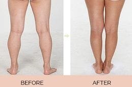 Calf Reduction Clinic in Dubai