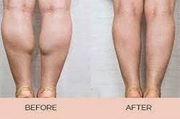 Calf Reduction Surgery Dubai & Abu Dhabi