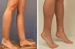Calf Reduction