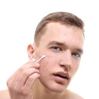 Can Acne Scars be Removed Permanently