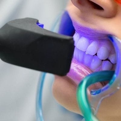 Can You Damage Your Teeth by Whitening in Dubai Dynamic Clinic