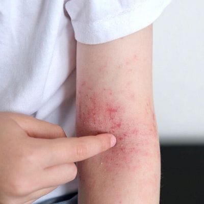Can a dermatologist treat scalp Eczema?