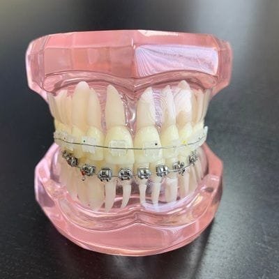 Ceramic Braces Cost in Dubai