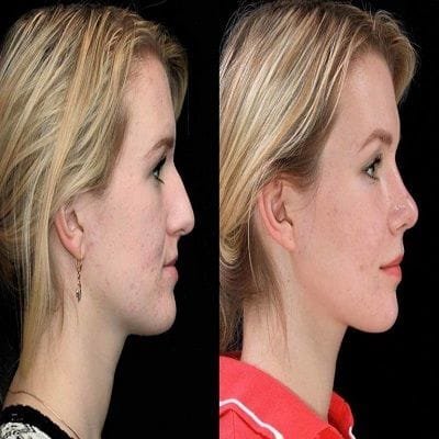 Chin Augmentation in Dubai