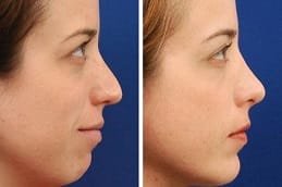 Chin Reduction Clinic in Dubai & Abu Dhabi