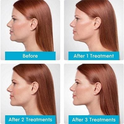 Chin Reduction in Dubai