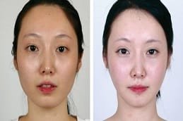 Chin Reduction Surgery in Dubai & Abu Dhabi