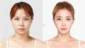 Chin Reduction Treatment