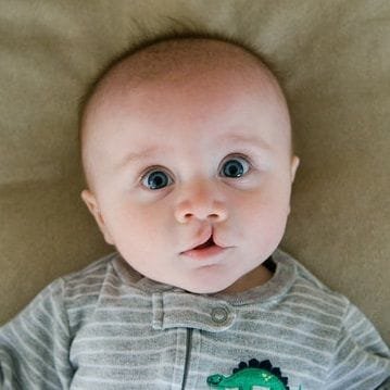 Cleft Lip Surgery in Dubai