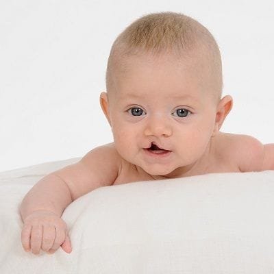 Cleft palate repair surgery cost in Dubai & Abu Dhabi | Cleft Lip