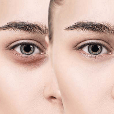 Dark Circles Treatment