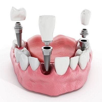 Dental Implant Clinic