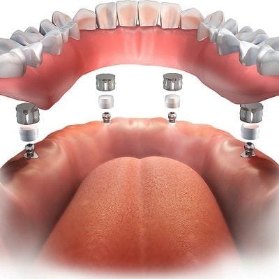 Dental Implant Procedure: Step-By-Step