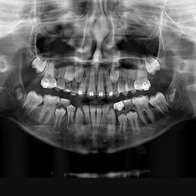 Dental Panoramic X-Ray Costs in Dubai