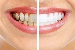 Dental Stains Removal in Dubai and Abu Dhabi