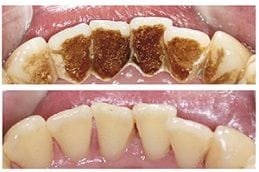 Dental Stains Removal in Dubai