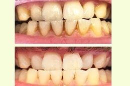 Dental Stains Removal