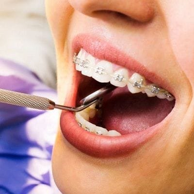 Dental braces cost in Dubai