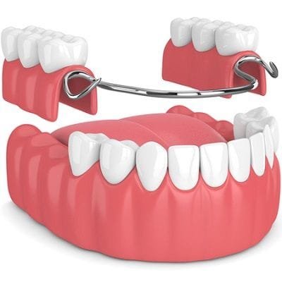Dentures vs Implants: Which is Right for You?