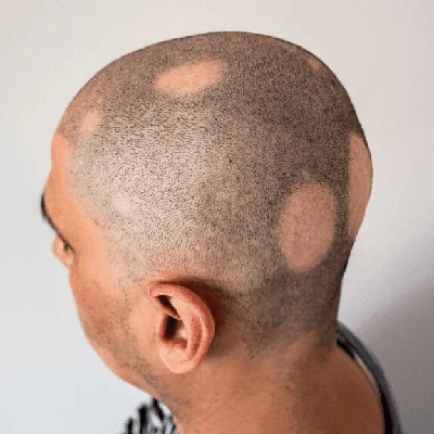 Difference Between Non-Scarring and Scarring Alopecia