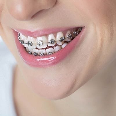 Do Metal Braces Damage Teeth?