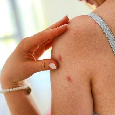 Do Pimples On Your Arms Bother You Here Are Treatments To Get Rid Of Them