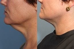Chin Liposuction 5 Double Chin Liposuction Clinic Dubai