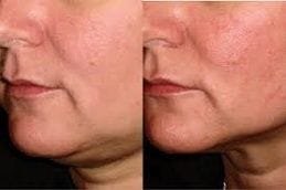 Chin Liposuction 6 Double Chin Liposuction Clinic in Dubai
