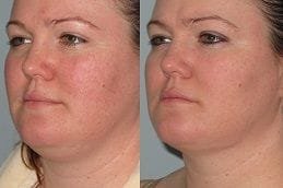 Chin Liposuction 4 Double Chin Liposuction Dubai