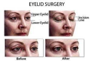 Eyelid Surgery Blepharoplasty in Dubai, Abu Dhabi & Sharjah
