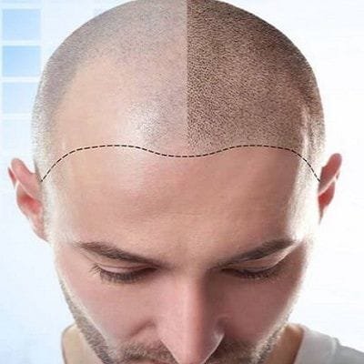 FUT Hair Transplant in Dubai