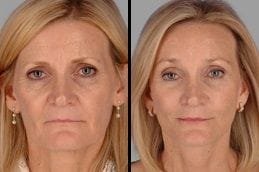 Face lift 5 Facelift in Dubai Before & After