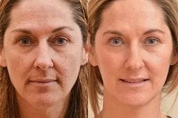 Factor Five Before After