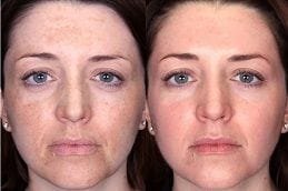 Factor Five Serum Before and After