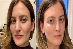 Factor Five Serum Before and Afters