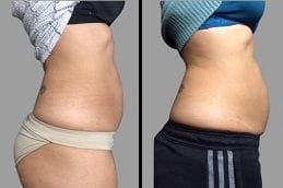 Fat Reduction Dubai Silicon Oasis Before & After