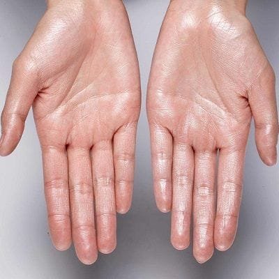 Miradry for Hands
